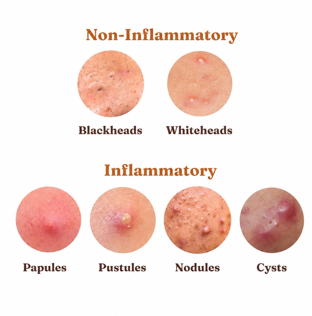Inflammatory vs. Non-Inflammatory Acne: How to Tell the Difference