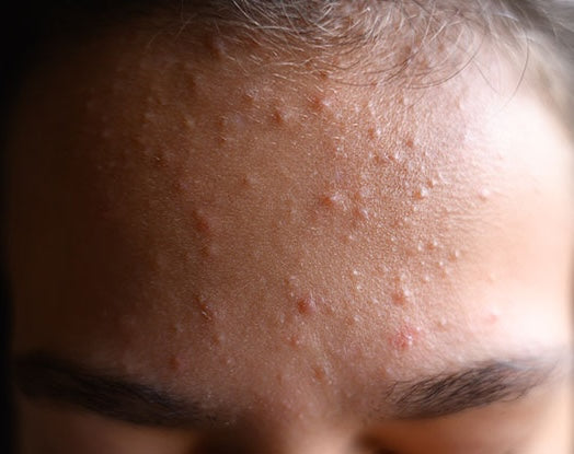 Closed Comedones, Blackheads, and Whiteheads: What Is the Difference?