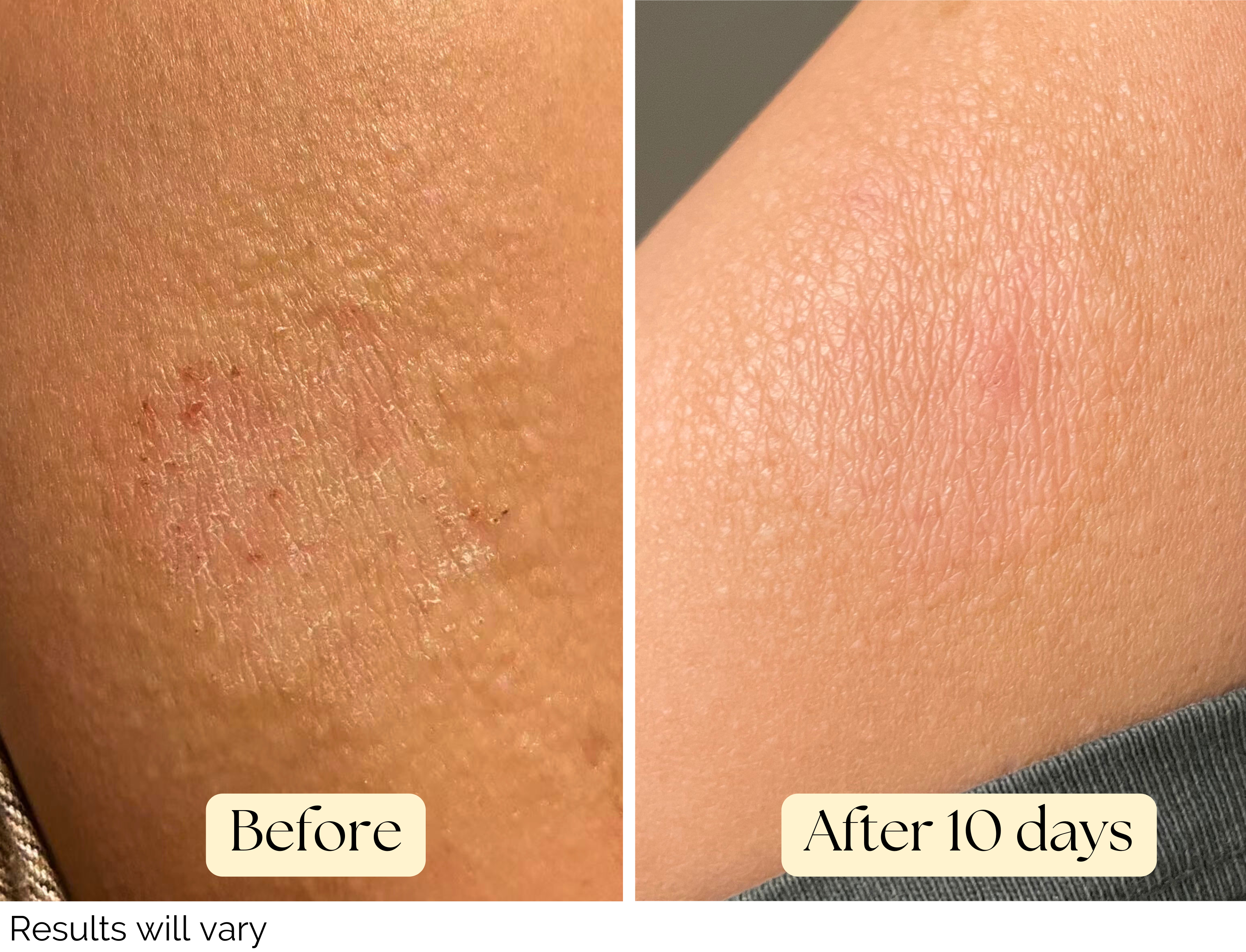 Before and after comparison of skin treatment on a person's arm with labels 'Before' and 'After 10 days'.