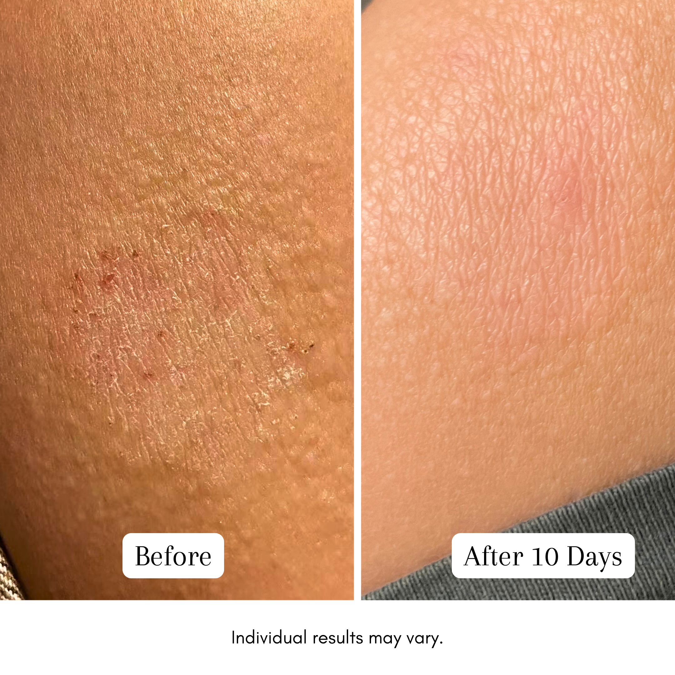 Purple Gromwell Relief Treatment