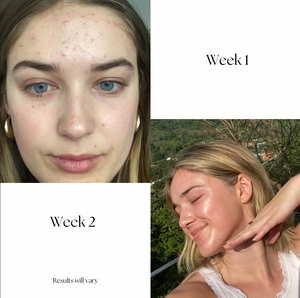 DermaGlow Acne Treatment Set