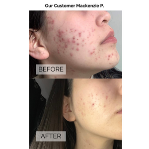 Acne Prevention Mask Box (Value $44)