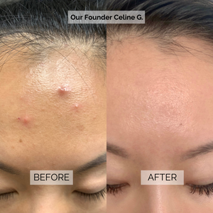 Acne Prevention Mask Box (Value $44)